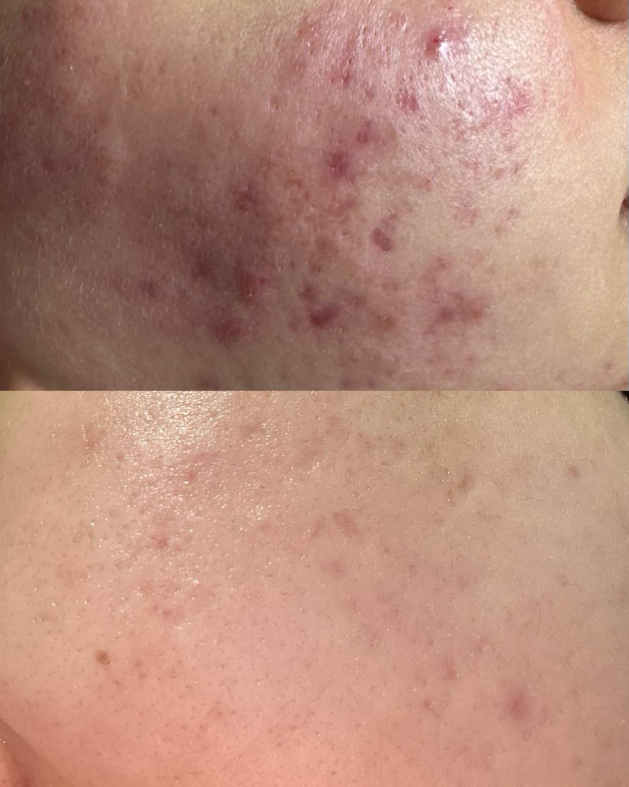 Maftuna — aknedan qutildi 🧴✨