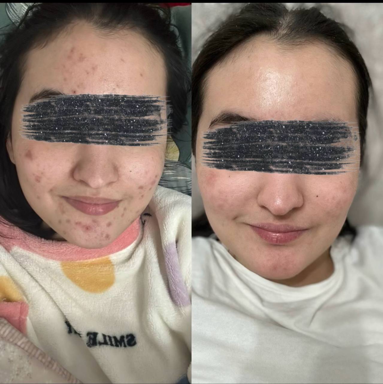 Dilnoza — noto'g'ri uhod tufayli toshmalardan xalos bo'ldi 🌿💫